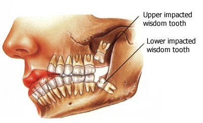 wisdom teeth removal auckland wisdom teeth removal auckland
