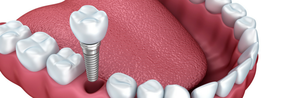 dental implant auckland
